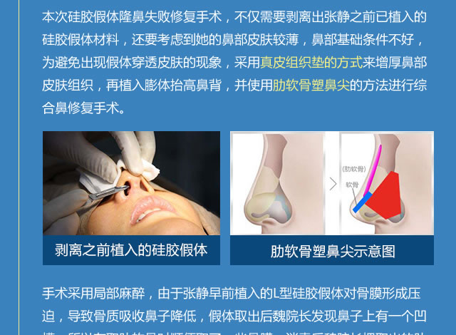 隆鼻失败修复手术示意图