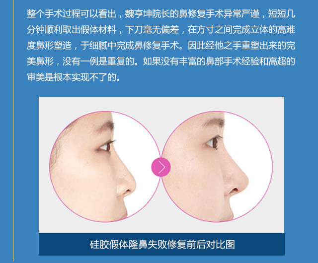 硅胶假体隆鼻失败修复前后对比图