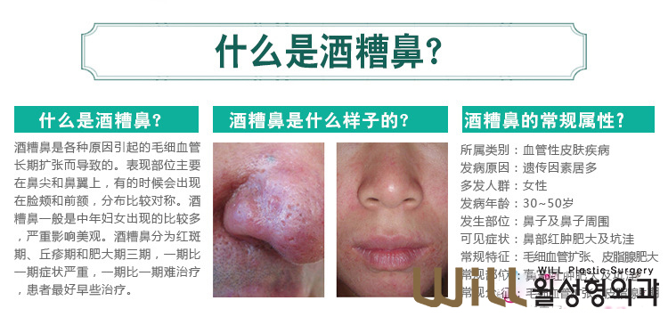 酒糟鼻形成的原因及症状