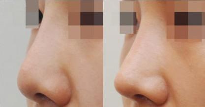 做了7次鼻子的女人，最后一次在韩国will拯救了朝天鼻