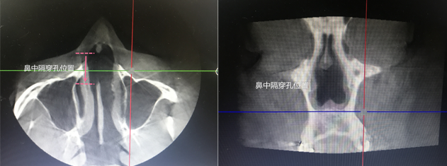 韩国will医院患者鼻中隔ct图