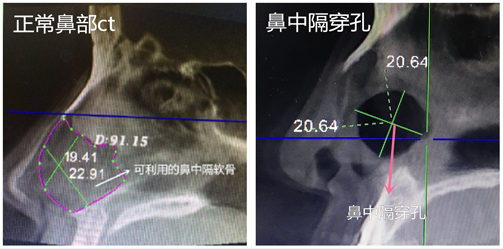 正常鼻骨ct与鼻中隔穿孔ct对比图