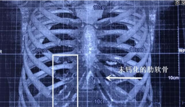 做鼻子能用肋软骨就别用耳软骨有道理没？钙化了还能用吗