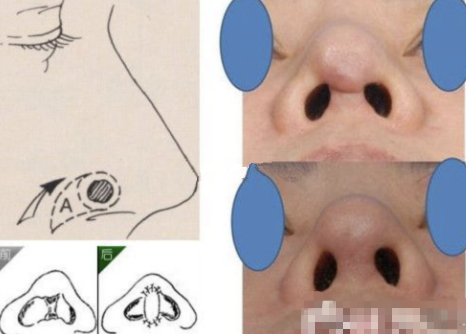 做完鼻子，鼻小柱那儿的手术切口挛缩变朝天鼻怎么办