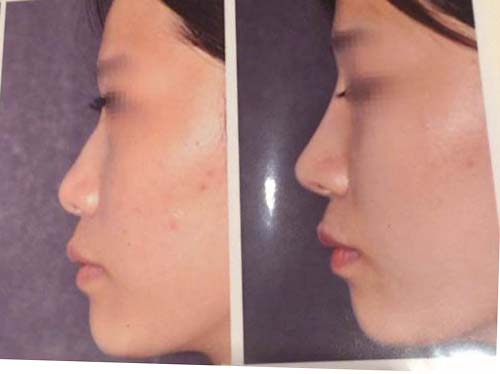 韩国will医院，低鼻 矮鼻整形案例