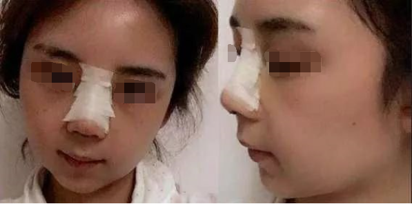 韩国will医院短鼻延长术后肿胀三天