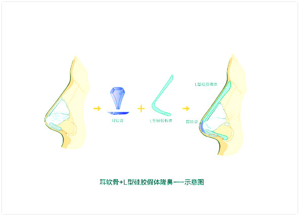 L型假体加自体软骨隆鼻