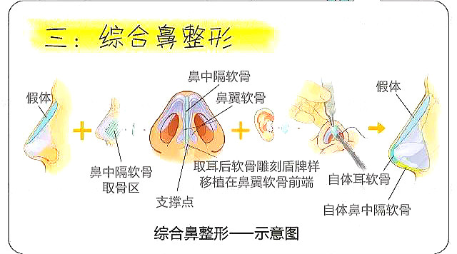 魏亨坤院长鼻综合整形