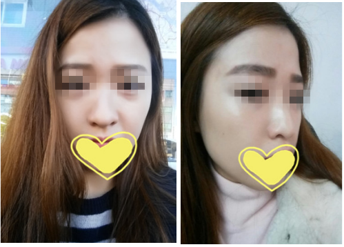 看我在韩国will医院做的假体隆鼻恢复两个月的日记！