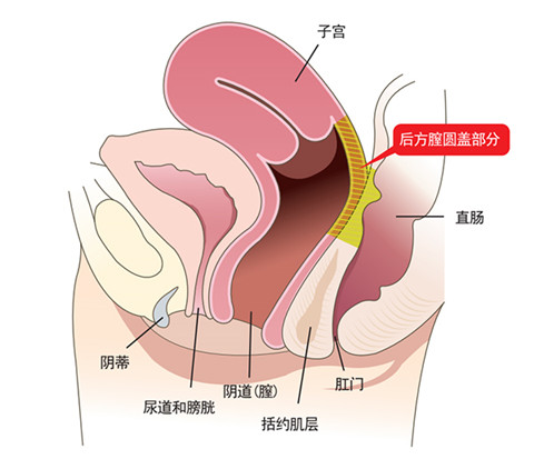 后方膣圆盖术缩术部位介绍
