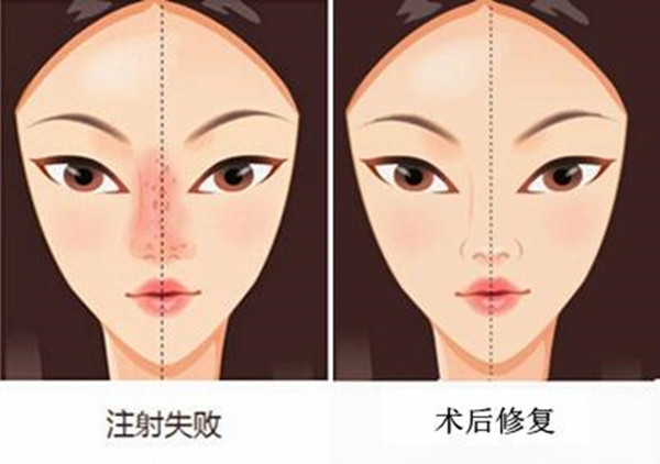 鼻修复常见的问题