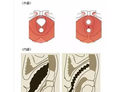 阴道紧缩术效果图.jpg