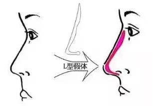 假体隆鼻模拟效果图