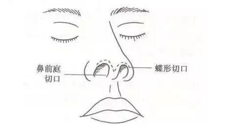 鼻综合隆鼻手术切口示意图