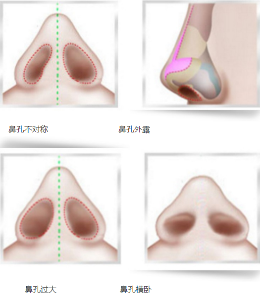 韩国will医院鼻孔畸形矫正图