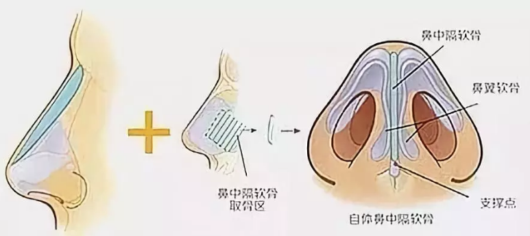 鼻中隔软骨隆鼻示意图