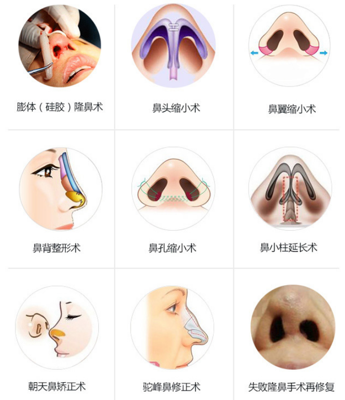 韩国will整形医院隆鼻手术可以改善鼻部哪些问题