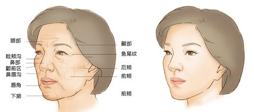 自体脂肪面部填充能改善脸部哪些问题