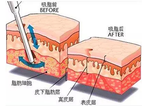 韩国腰腹吸脂手术效果