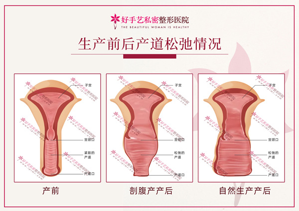 1.生产前后产道情况对比水印版.jpg