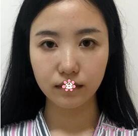 在韩国will医院的经历告诉我膨体隆鼻感染率并没有那么高