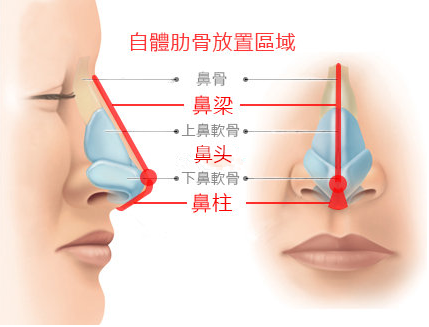 鼻假体放置部位