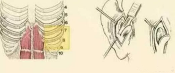 取肋骨和耳软骨