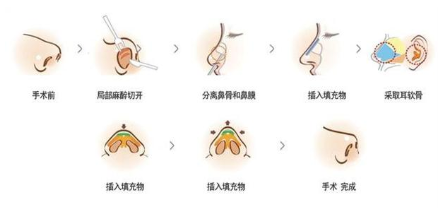 耳软骨填充鼻尖的过程图