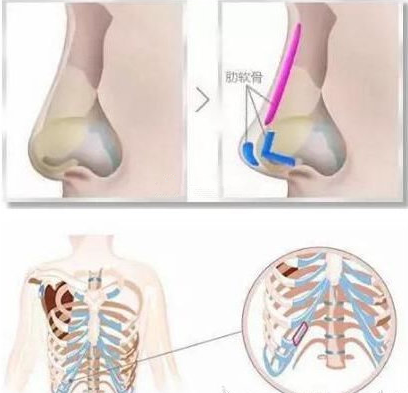 肋软骨隆鼻